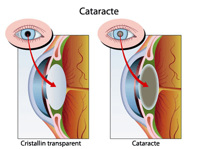 La cataracte